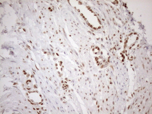 MGMT Antibody - Immunohistochemical staining of paraffin-embedded Human endometrium tissue within the normal limits using anti-MGMT mouse monoclonal antibody. (Heat-induced epitope retrieval by 1mM EDTA in 10mM Tris buffer. (pH8.5) at 120°C for 3 min. (1:150)