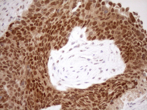 MGMT Antibody - Immunohistochemical staining of paraffin-embedded Adenocarcinoma of Human endometrium tissue using anti-MGMT mouse monoclonal antibody. (Heat-induced epitope retrieval by 1mM EDTA in 10mM Tris buffer. (pH8.5) at 120°C for 3 min. (1:150)