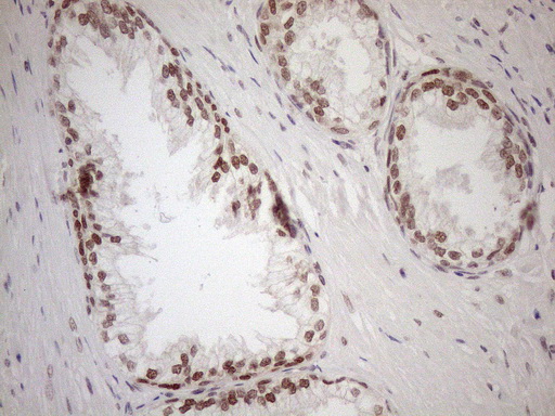 MGMT Antibody - Immunohistochemical staining of paraffin-embedded Human prostate tissue within the normal limits using anti-MGMT mouse monoclonal antibody. (Heat-induced epitope retrieval by 1mM EDTA in 10mM Tris buffer. (pH8.5) at 120°C for 3 min. (1:150)