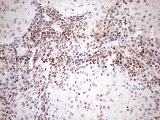 MGMT Antibody - Immunohistochemical staining of paraffin-embedded Human lymph node tissue within the normal limits using anti-MGMT mouse monoclonal antibody. (Heat-induced epitope retrieval by 1mM EDTA in 10mM Tris buffer. (pH8.5) at 120°C for 3 min. (1:150)