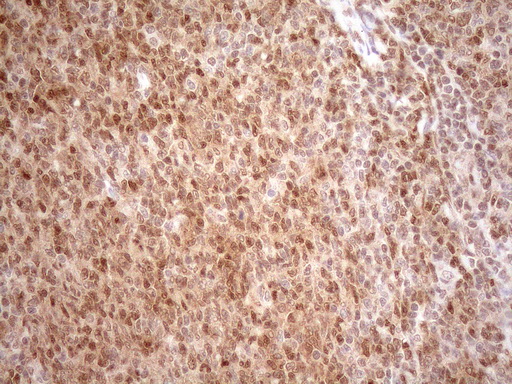 MGMT Antibody - Immunohistochemical staining of paraffin-embedded Human lymphoma tissue using anti-MGMT mouse monoclonal antibody. (Heat-induced epitope retrieval by 1mM EDTA in 10mM Tris buffer. (pH8.5) at 120°C for 3 min. (1:150)