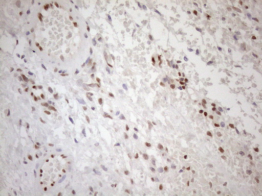 MGMT Antibody - Immunohistochemical staining of paraffin-embedded Human Ovary tissue within the normal limits using anti-MGMT mouse monoclonal antibody. (Heat-induced epitope retrieval by 1mM EDTA in 10mM Tris buffer. (pH8.5) at 120°C for 3 min. (1:150)
