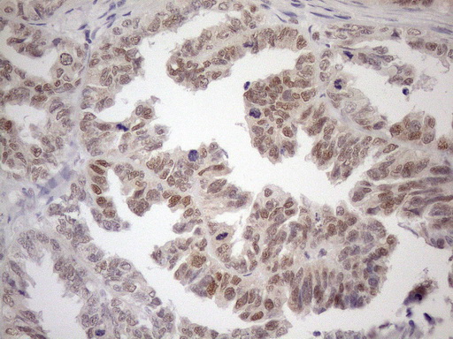 MGMT Antibody - Immunohistochemical staining of paraffin-embedded Adenocarcinoma of Human ovary tissue using anti-MGMT mouse monoclonal antibody. (Heat-induced epitope retrieval by 1mM EDTA in 10mM Tris buffer. (pH8.5) at 120°C for 3 min. (1:150)
