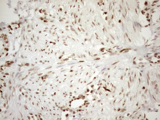 MGMT Antibody - Immunohistochemical staining of paraffin-embedded Human endometrium tissue within the normal limits using anti-MGMT mouse monoclonal antibody. (Heat-induced epitope retrieval by 1mM EDTA in 10mM Tris buffer. (pH8.5) at 120°C for 3 min. (1:150)
