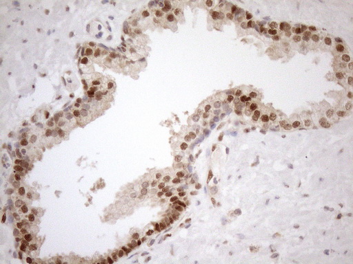 MGMT Antibody - Immunohistochemical staining of paraffin-embedded Carcinoma of Human prostate tissue using anti-MGMT mouse monoclonal antibody. (Heat-induced epitope retrieval by 1mM EDTA in 10mM Tris buffer. (pH8.5) at 120°C for 3 min. (1:150)