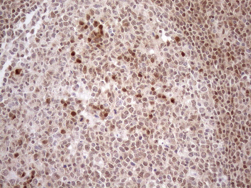 MGMT Antibody - Immunohistochemical staining of paraffin-embedded Human tonsil within the normal limits using anti-MGMT mouse monoclonal antibody. (Heat-induced epitope retrieval by 1mM EDTA in 10mM Tris buffer. (pH8.5) at 120°C for 3 min. (1:150)