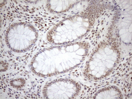 MGMT Antibody - Immunohistochemical staining of paraffin-embedded Human colon tissue within the normal limits using anti-MGMT mouse monoclonal antibody. (Heat-induced epitope retrieval by 1mM EDTA in 10mM Tris buffer. (pH8.5) at 120°C for 3 min. (1:150)
