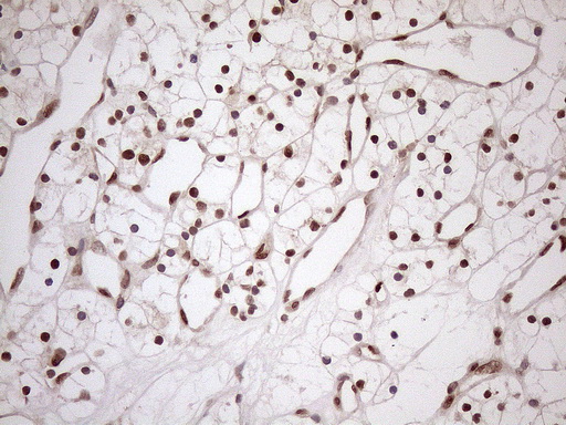 MGMT Antibody - Immunohistochemical staining of paraffin-embedded Carcinoma of Human kidney tissue using anti-MGMT mouse monoclonal antibody. (Heat-induced epitope retrieval by 1mM EDTA in 10mM Tris buffer. (pH8.5) at 120°C for 3 min. (1:150)