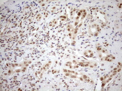 MGMT Antibody - Immunohistochemical staining of paraffin-embedded Carcinoma of Human liver tissue using anti-MGMT mouse monoclonal antibody. (Heat-induced epitope retrieval by 1mM EDTA in 10mM Tris buffer. (pH8.5) at 120°C for 3 min. (1:150)