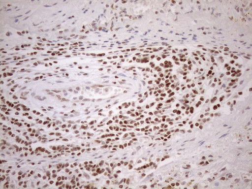 MGMT Antibody - Immunohistochemical staining of paraffin-embedded Carcinoma of Human lung tissue using anti-MGMT mouse monoclonal antibody. (Heat-induced epitope retrieval by 1mM EDTA in 10mM Tris buffer. (pH8.5) at 120°C for 3 min. (1:150)