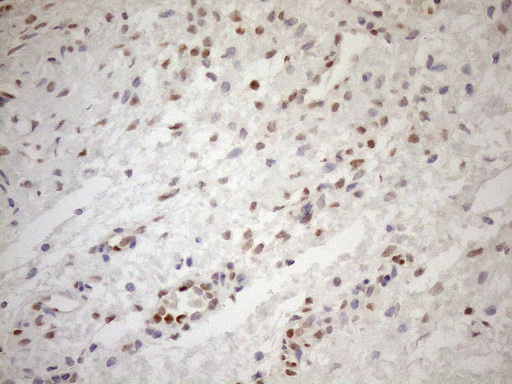 MGMT Antibody - Immunohistochemical staining of paraffin-embedded Human Ovary tissue within the normal limits using anti-MGMT mouse monoclonal antibody. (Heat-induced epitope retrieval by 1mM EDTA in 10mM Tris buffer. (pH8.5) at 120°C for 3 min. (1:150)