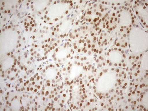 MGMT Antibody - Immunohistochemical staining of paraffin-embedded Human thyroid tissue within the normal limits using anti-MGMT mouse monoclonal antibody. (Heat-induced epitope retrieval by 1mM EDTA in 10mM Tris buffer. (pH8.5) at 120°C for 3 min. (1:150)