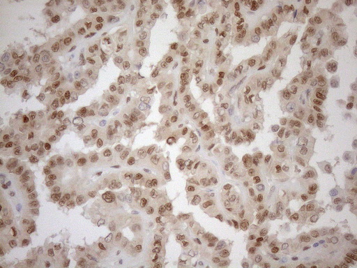 MGMT Antibody - Immunohistochemical staining of paraffin-embedded Carcinoma of Human thyroid tissue using anti-MGMT mouse monoclonal antibody. (Heat-induced epitope retrieval by 1mM EDTA in 10mM Tris buffer. (pH8.5) at 120°C for 3 min. (1:150)