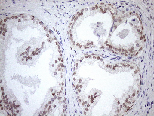MGMT Antibody - Immunohistochemical staining of paraffin-embedded Human prostate tissue within the normal limits using anti-MGMT mouse monoclonal antibody. (Heat-induced epitope retrieval by 1mM EDTA in 10mM Tris buffer. (pH8.5) at 120°C for 3 min. (1:150)