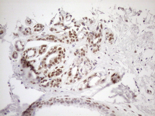 MGMT Antibody - Immunohistochemical staining of paraffin-embedded Adenocarcinoma of Human breast tissue using anti-MGMT mouse monoclonal antibody. (Heat-induced epitope retrieval by 1mM EDTA in 10mM Tris buffer. (pH8.5) at 120°C for 3 min. (1:150)