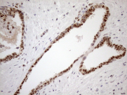 MGMT Antibody - Immunohistochemical staining of paraffin-embedded Carcinoma of Human prostate tissue using anti-MGMT mouse monoclonal antibody. (Heat-induced epitope retrieval by 1mM EDTA in 10mM Tris buffer. (pH8.5) at 120°C for 3 min. (1:150)
