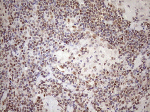 MGMT Antibody - Immunohistochemical staining of paraffin-embedded Human lymph node tissue within the normal limits using anti-MGMT mouse monoclonal antibody. (Heat-induced epitope retrieval by 1mM EDTA in 10mM Tris buffer. (pH8.5) at 120°C for 3 min. (1:150)