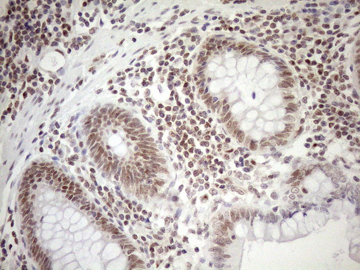 MGMT Antibody - Immunohistochemical staining of paraffin-embedded Human colon tissue within the normal limits using anti-MGMT mouse monoclonal antibody. (Heat-induced epitope retrieval by 1mM EDTA in 10mM Tris buffer. (pH8.5) at 120°C for 3 min. (1:150)