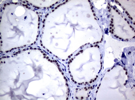 MGMT Antibody - Immunohistochemical staining of paraffin-embedded Human thyroid tissue using anti-MGMT mouse monoclonal antibody.  heat-induced epitope retrieval by 10mM citric buffer, pH6.0, 120C for 3min)