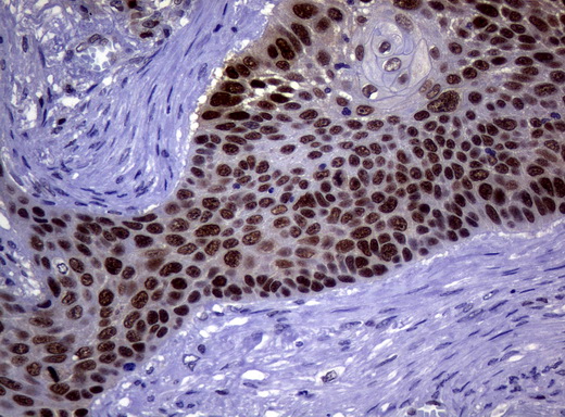 MGMT Antibody - Immunohistochemical staining of paraffin-embedded Carcinoma of Human lung tissue using anti-MGMT mouse monoclonal antibody.  heat-induced epitope retrieval by 10mM citric buffer, pH6.0, 120C for 3min)