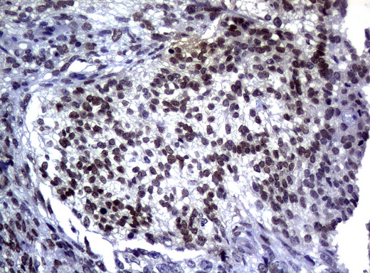 MGMT Antibody - Immunohistochemical staining of paraffin-embedded Adenocarcinoma of Human endometrium tissue using anti-MGMT mouse monoclonal antibody.  heat-induced epitope retrieval by 10mM citric buffer, pH6.0, 120C for 3min)