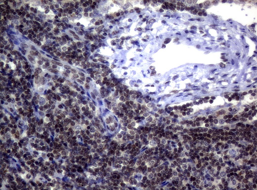 MGMT Antibody - Immunohistochemical staining of paraffin-embedded Human lymph node tissue using anti-MGMT mouse monoclonal antibody.  heat-induced epitope retrieval by 10mM citric buffer, pH6.0, 120C for 3min)