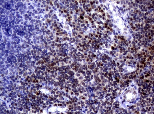 MGMT Antibody - Immunohistochemical staining of paraffin-embedded Human tonsil using anti-MGMT mouse monoclonal antibody.  heat-induced epitope retrieval by 10mM citric buffer, pH6.0, 120C for 3min)