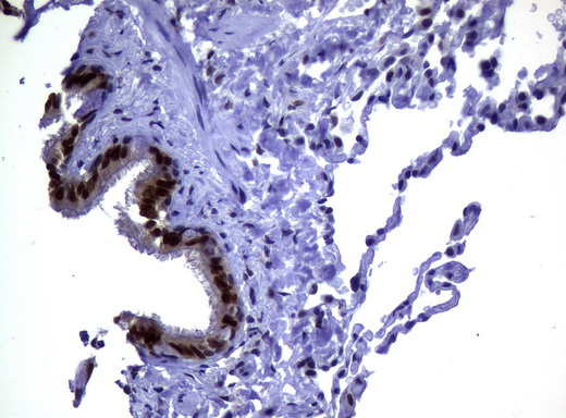 MGMT Antibody - Immunohistochemical staining of paraffin-embedded Human lung tissue using anti-MGMT mouse monoclonal antibody.  heat-induced epitope retrieval by 10mM citric buffer, pH6.0, 120C for 3min)