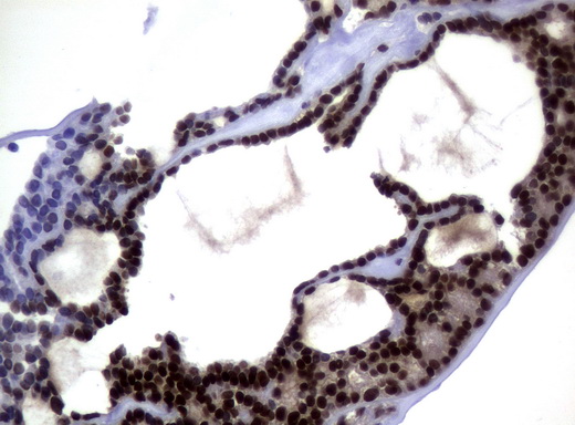 MGMT Antibody - Immunohistochemical staining of paraffin-embedded Carcinoma of Human thyroid tissue using anti-MGMT mouse monoclonal antibody.  heat-induced epitope retrieval by 10mM citric buffer, pH6.0, 120C for 3min)