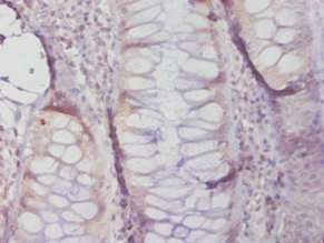MGMT Antibody - Immunohistochemistry of paraffin-embedded human colon cancer using MGMT Antibody at dilution of 1:20