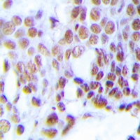 MGMT Antibody - Immunohistochemical analysis of MGMT staining in human prostate cancer formalin fixed paraffin embedded tissue section. The section was pre-treated using heat mediated antigen retrieval with sodium citrate buffer (pH 6.0). The section was then incubated with the antibody at room temperature and detected using an HRP polymer system. DAB was used as the chromogen. The section was then counterstained with hematoxylin and mounted with DPX.
