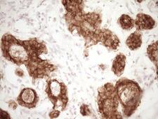 MGP / Matrix Gla-Protein Antibody - Immunohistochemical staining of paraffin-embedded Adenocarcinoma of Human breast tissue using anti-MGP mouse monoclonal antibody. (Heat-induced epitope retrieval by 1 mM EDTA in 10mM Tris, pH8.5, 120C for 3min,