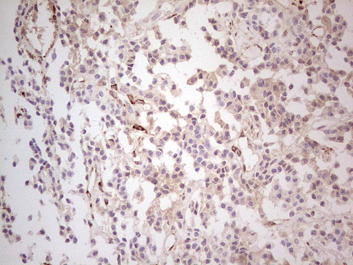 MGP / Matrix Gla-Protein Antibody - Immunohistochemical staining of paraffin-embedded Carcinoma of Human lung tissue using anti-MGP mouse monoclonal antibody. (Heat-induced epitope retrieval by Tris-EDTA, pH8.0) Dilution: 1:150