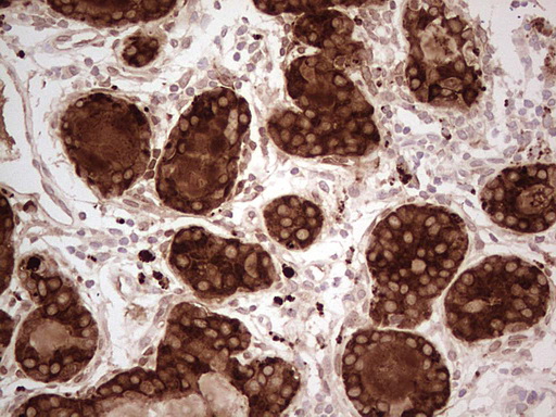 MGP / Matrix Gla-Protein Antibody - Immunohistochemical staining of paraffin-embedded Adenocarcinoma of Human breast tissue using anti-MGP mouse monoclonal antibody. (Heat-induced epitope retrieval by Tris-EDTA, pH8.0) Dilution: 1:150