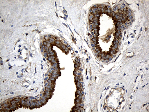 MGP / Matrix Gla-Protein Antibody - Immunohistochemical staining of paraffin-embedded Human breast tissue within the normal limits using anti-MGP mouse monoclonal antibody. (Heat-induced epitope retrieval by 1mM EDTA in 10mM Tris buffer. (pH8.5) at 120°C for 3 min. (1:500)