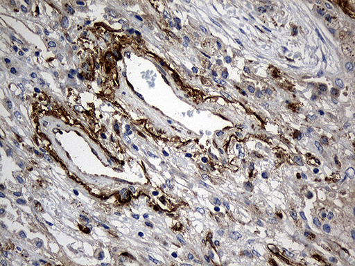 MGP / Matrix Gla-Protein Antibody - Immunohistochemical staining of paraffin-embedded Carcinoma of Human lung tissue using anti-MGP mouse monoclonal antibody. (Heat-induced epitope retrieval by 1mM EDTA in 10mM Tris buffer. (pH8.5) at 120°C for 3 min. (1:500)
