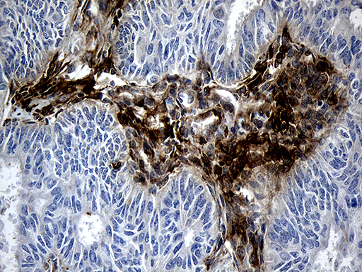 MGP / Matrix Gla-Protein Antibody - Immunohistochemical staining of paraffin-embedded Adenocarcinoma of Human endometrium tissue using anti-MGP mouse monoclonal antibody. (Heat-induced epitope retrieval by 1mM EDTA in 10mM Tris buffer. (pH8.5) at 120°C for 3 min. (1:500)