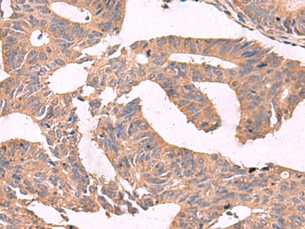 MGP / Matrix Gla-Protein Antibody - Immunohistochemistry of paraffin-embedded Human colorectal cancer tissue  using MGP Polyclonal Antibody at dilution of 1:75(×200)
