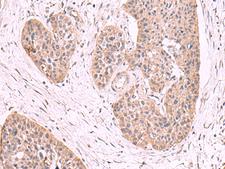 MGP / Matrix Gla-Protein Antibody - Immunohistochemistry of paraffin-embedded Human esophagus cancer tissue  using MGP Polyclonal Antibody at dilution of 1:50(×200)