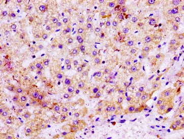 MGST1 Antibody - Immunohistochemistry image at a dilution of 1:100 and staining in paraffin-embedded human liver tissue performed on a Leica BondTM system. After dewaxing and hydration, antigen retrieval was mediated by high pressure in a citrate buffer (pH 6.0) . Section was blocked with 10% normal goat serum 30min at RT. Then primary antibody (1% BSA) was incubated at 4 °C overnight. The primary is detected by a biotinylated secondary antibody and visualized using an HRP conjugated SP system.