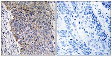 MGST3 Antibody - Peptide - + Immunohistochemistry analysis of paraffin-embedded human lung carcinoma tissue using MGST3 antibody.