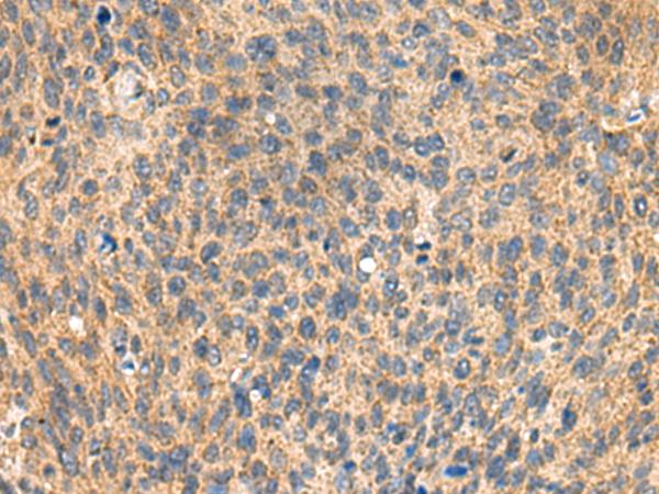 MIA / CD-RAP Antibody - Immunohistochemistry of paraffin-embedded Human cervical cancer tissue  using MIA Polyclonal Antibody at dilution of 1:100(×200)