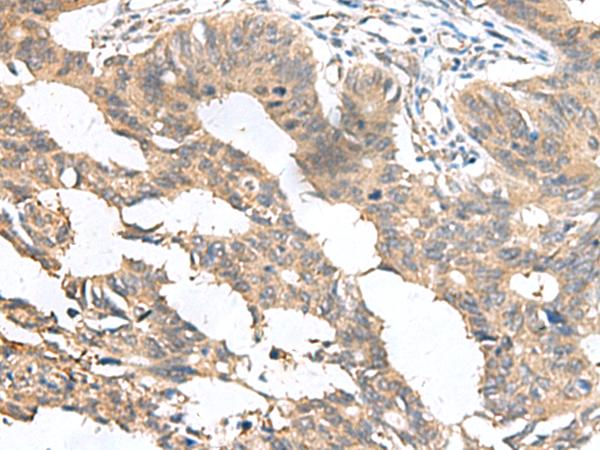 MIA / CD-RAP Antibody - Immunohistochemistry of paraffin-embedded Human colorectal cancer tissue  using MIA Polyclonal Antibody at dilution of 1:100(×200)