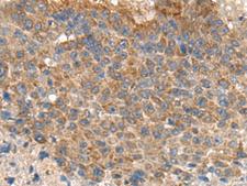 MIA / CD-RAP Antibody - Immunohistochemistry of paraffin-embedded Human liver cancer tissue  using MIA Polyclonal Antibody at dilution of 1:180(×200)