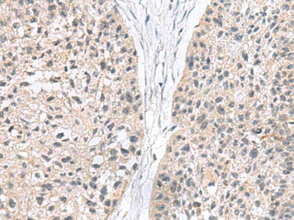 MIA / CD-RAP Antibody - Immunohistochemistry of paraffin-embedded Human esophagus cancer tissue  using MIA Polyclonal Antibody at dilution of 1:180(×200)