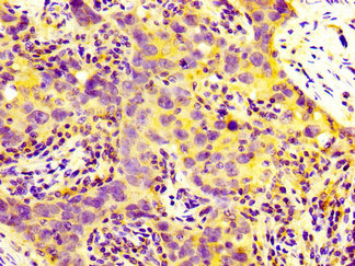 MIA2 Antibody - Immunohistochemistry image at a dilution of 1:300 and staining in paraffin-embedded human pancreatic cancer performed on a Leica BondTM system. After dewaxing and hydration, antigen retrieval was mediated by high pressure in a citrate buffer (pH 6.0) . Section was blocked with 10% normal goat serum 30min at RT. Then primary antibody (1% BSA) was incubated at 4 °C overnight. The primary is detected by a biotinylated secondary antibody and visualized using an HRP conjugated SP system.