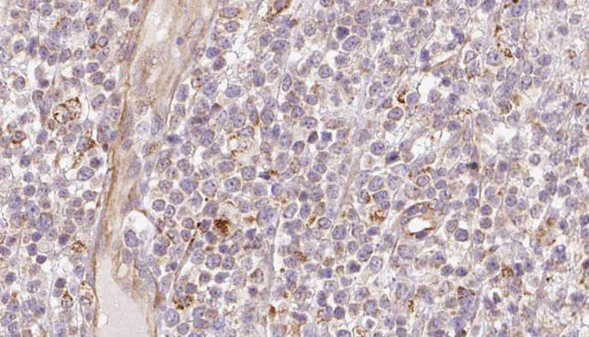 MIA40 / CHCHD4 Antibody - 1:100 staining human lymph carcinoma tissue by IHC-P. The sample was formaldehyde fixed and a heat mediated antigen retrieval step in citrate buffer was performed. The sample was then blocked and incubated with the antibody for 1.5 hours at 22°C. An HRP conjugated goat anti-rabbit antibody was used as the secondary.