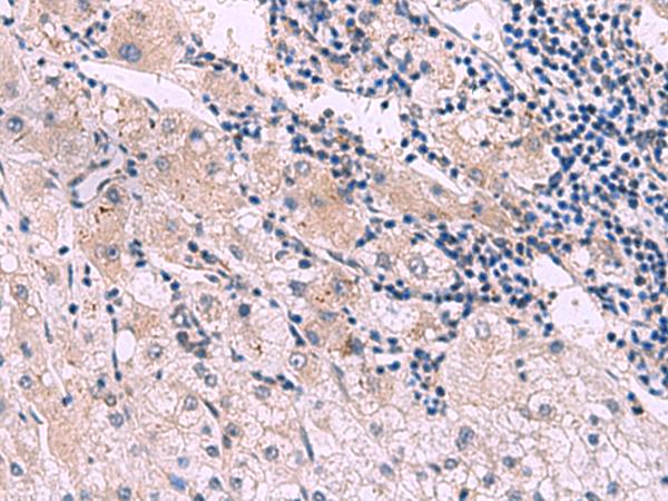 MIBP / ITGB1BP3 Antibody - Immunohistochemistry of paraffin-embedded Human liver cancer tissue  using NMRK2 Polyclonal Antibody at dilution of 1:55(×200)