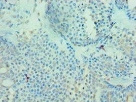MICA Antibody - Immunohistochemistry of paraffin-embedded human breast cancer using antibody at 1:100 dilution.
