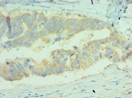 MICA Antibody - Immunohistochemistry of paraffin-embedded human colon cancer using antibody at 1:100 dilution.